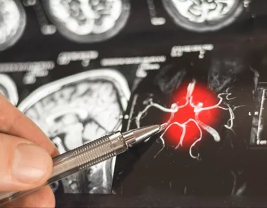 Miniatura: Będzie zmiana w leczeniu alzheimera? Jest...