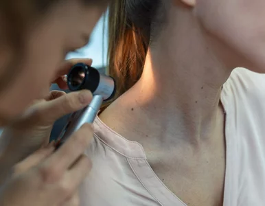 Miniatura: Sprawdzaj zmiany na skórze. Eksperci...