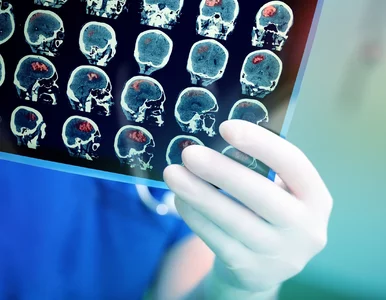 Miniatura: Nowa terapia cofa skutki Alzheimera....