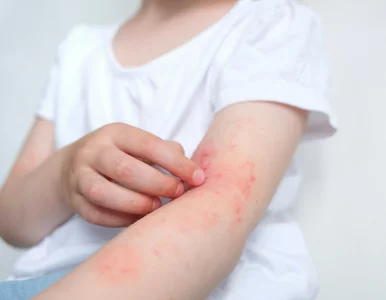 Miniatura: Ból poparzenia jest łatwiejszy do...