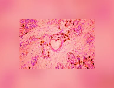 Miniatura: Nowotwór pod mikroskopem. Wyjątkowa...