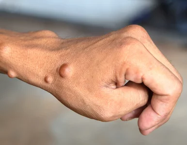 Miniatura: Pilotaż dla pacjentów z rzadką chorobą...