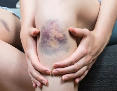 Miniatura: Nie chciały jej zniknąć siniaki. Diagnoza...