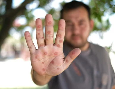 Miniatura: Ospa wietrzna to jedna z najbardziej...