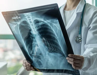 Miniatura: „Zwykły kaszel czy objaw gruźlicy?...