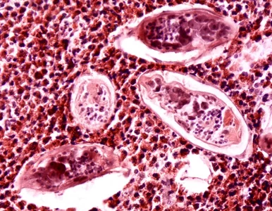Miniatura: Nie tylko HPV. Rak szyjki macicy może...