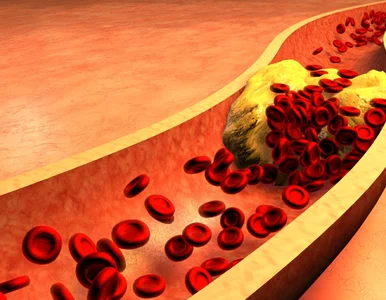 Miniatura: Kardiolog o mitach związanych z miażdżycą,...