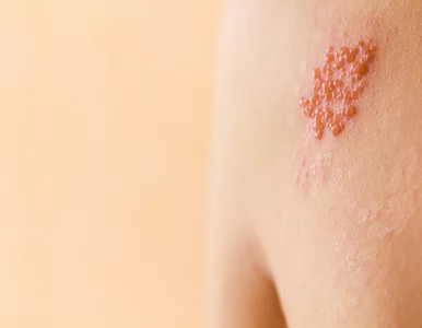 Miniatura: Półpasiec grozi milionom Polaków. Eksperci...