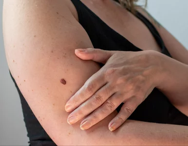 Miniatura: NFZ alarmuje: 300 proc. wzrost zachorowań...