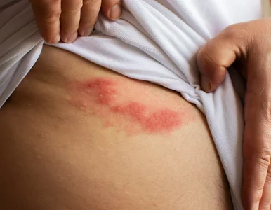 Miniatura: Fakty i mity na temat półpaśca. O tym...