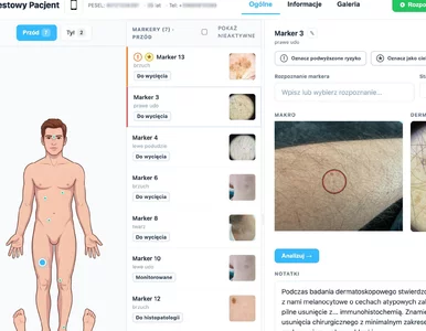 Miniatura: Smartfon pomoże ocenić niepokojącą zmianę...